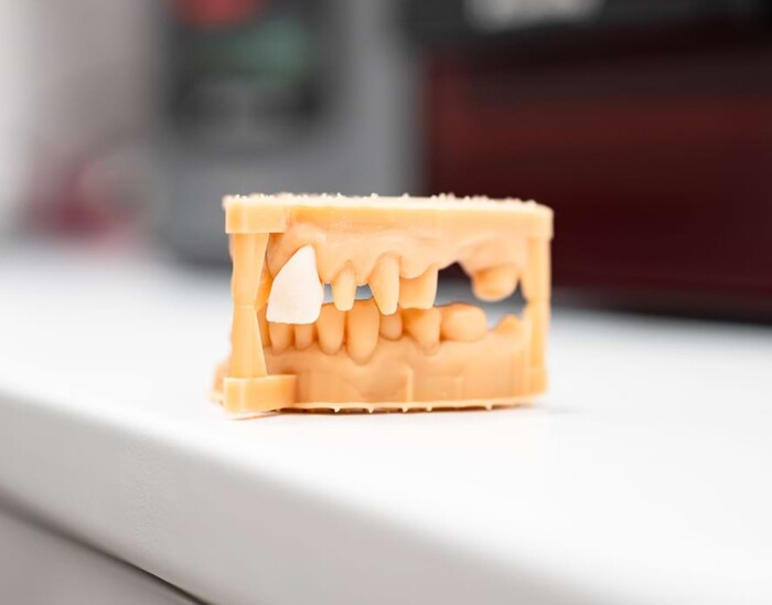 Nahaufnahme eines Zahnmodells mit Keramik-Inlay.